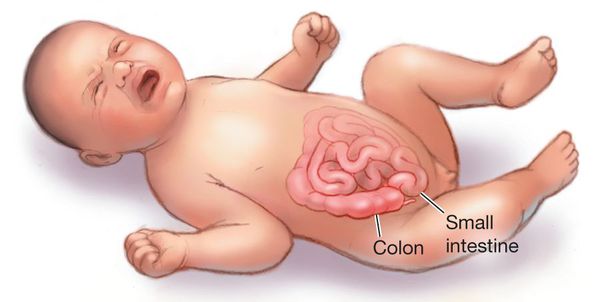 Внезапное беспокойство малыша при инвагинации кишечника