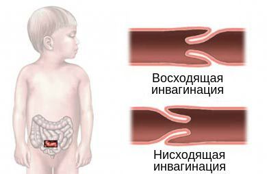 Восходящая и нисходящая инвагинация