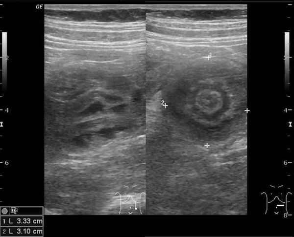 УЗ-признаки инвагинации кишечника