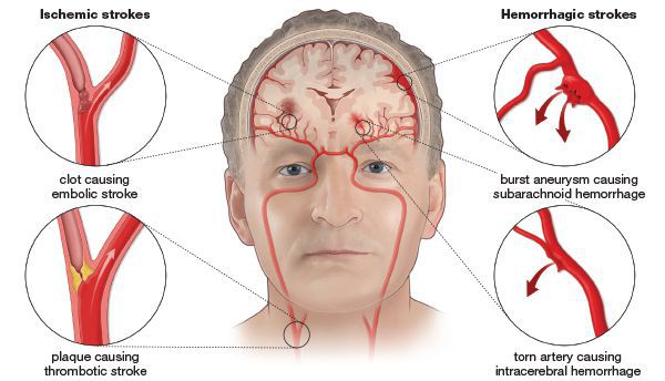 Закупорка и разрыв сосудов головного мозга