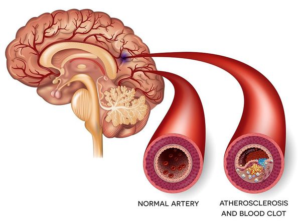 Мозговой атеросклероз