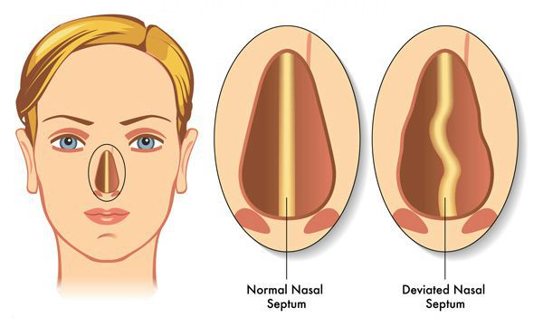 Искривление перегородки носа