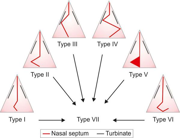Типы искривления носовой перегородки