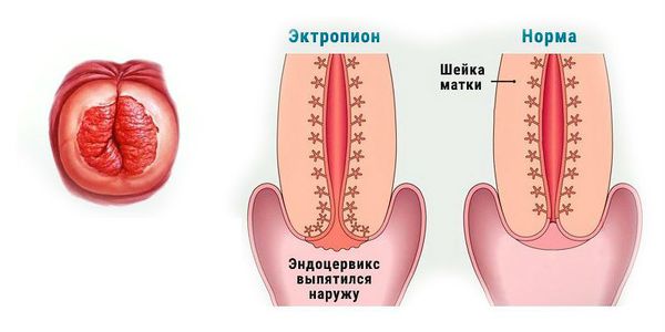 Выворот слизистой шеечного канала в полость влагалища