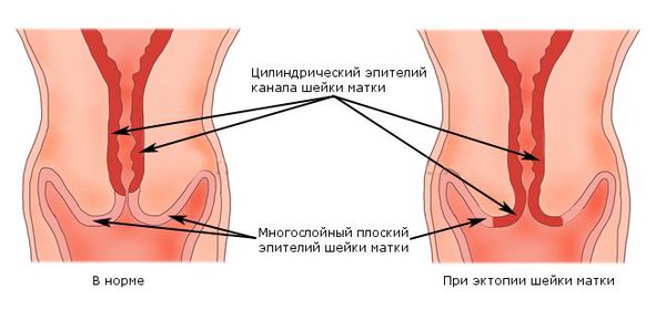 Шейка матки в норме и при эктопии