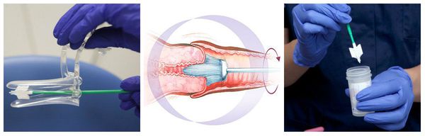 Мазок на онкоцитологию