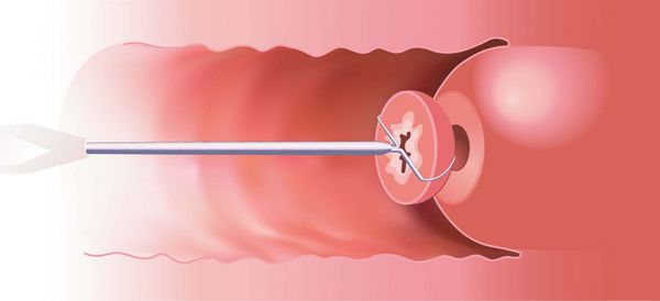 Эксцизия шейки матки