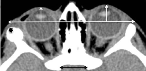 Энофтальм правого глаза на КТ 