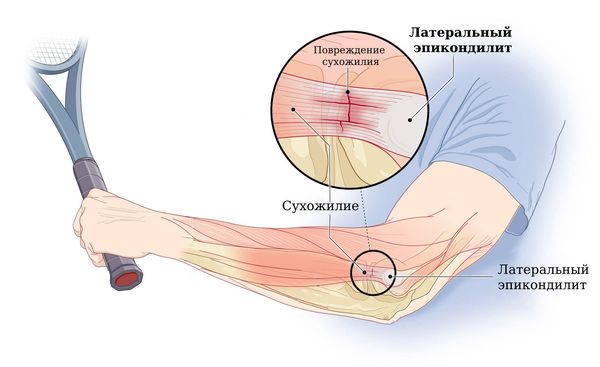Латеральный эпикондилит («локоть теннисиста»)