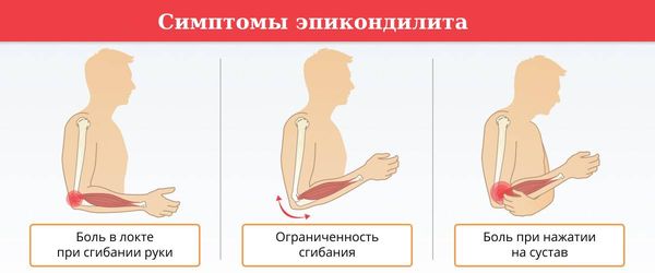 Симптомы эпикондилита