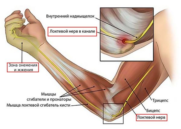 Неврит локтевого нерва