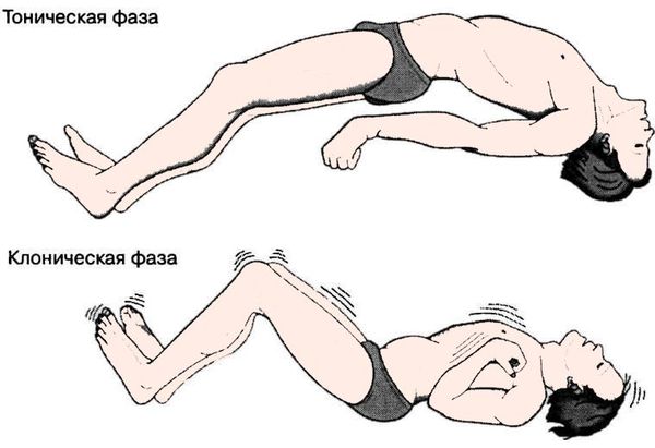 Тоническая и клоническая фазы приступа