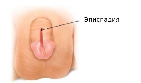 Эписпадия