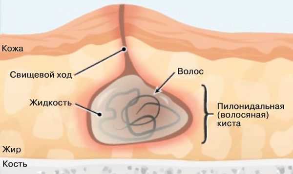 Патогенез эпителиального копчикового хода