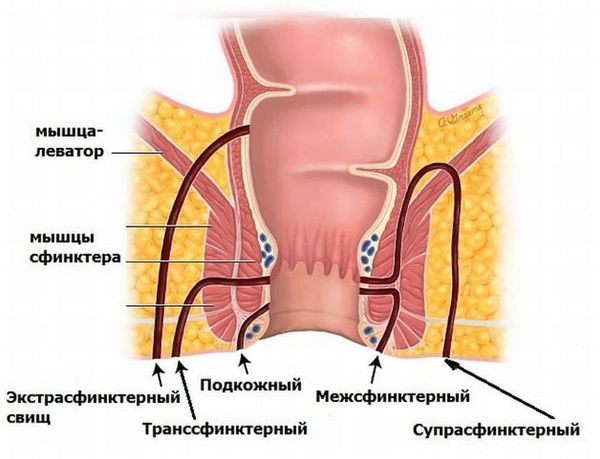 Свищ прямой кишки