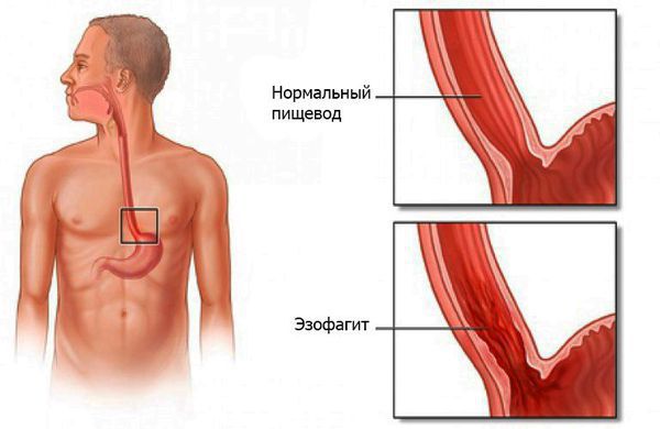 Эзофагит