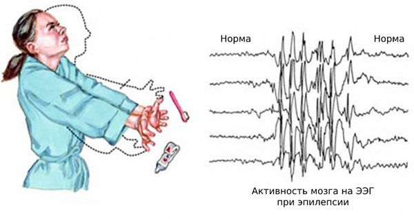 Приступ при юношеской миоклонической эпилепсии 