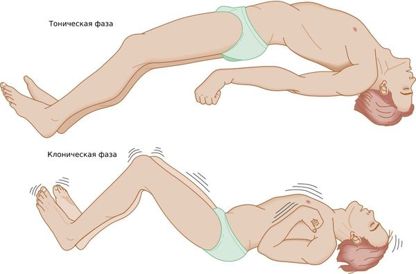Тоническая и клоническая фазы судорог