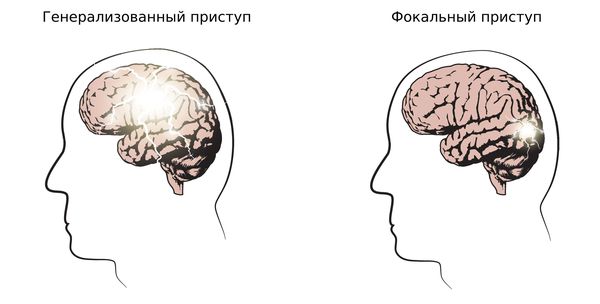 Генерализованный и фокальный приступы