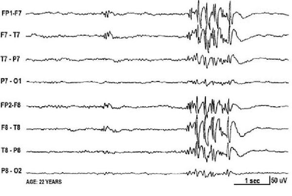 ЭЭГ при ювенильной миоклонической эпилепсии