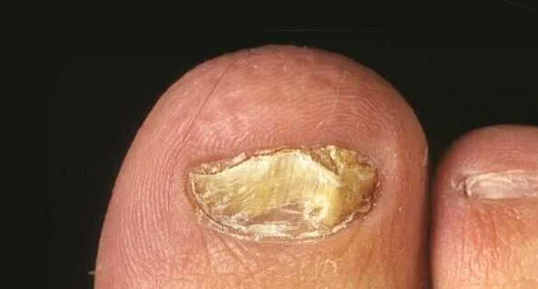 Основные причины возникновения грибка ногтей