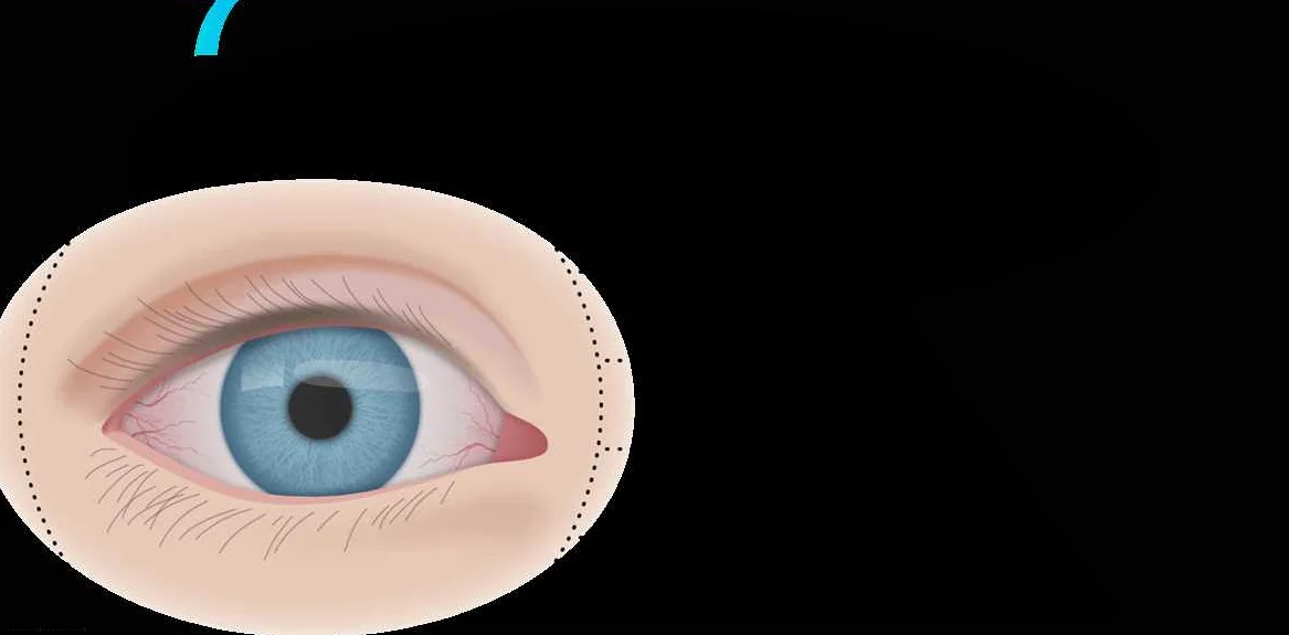 Сухой глаз при глаукоме. Глазки сухо