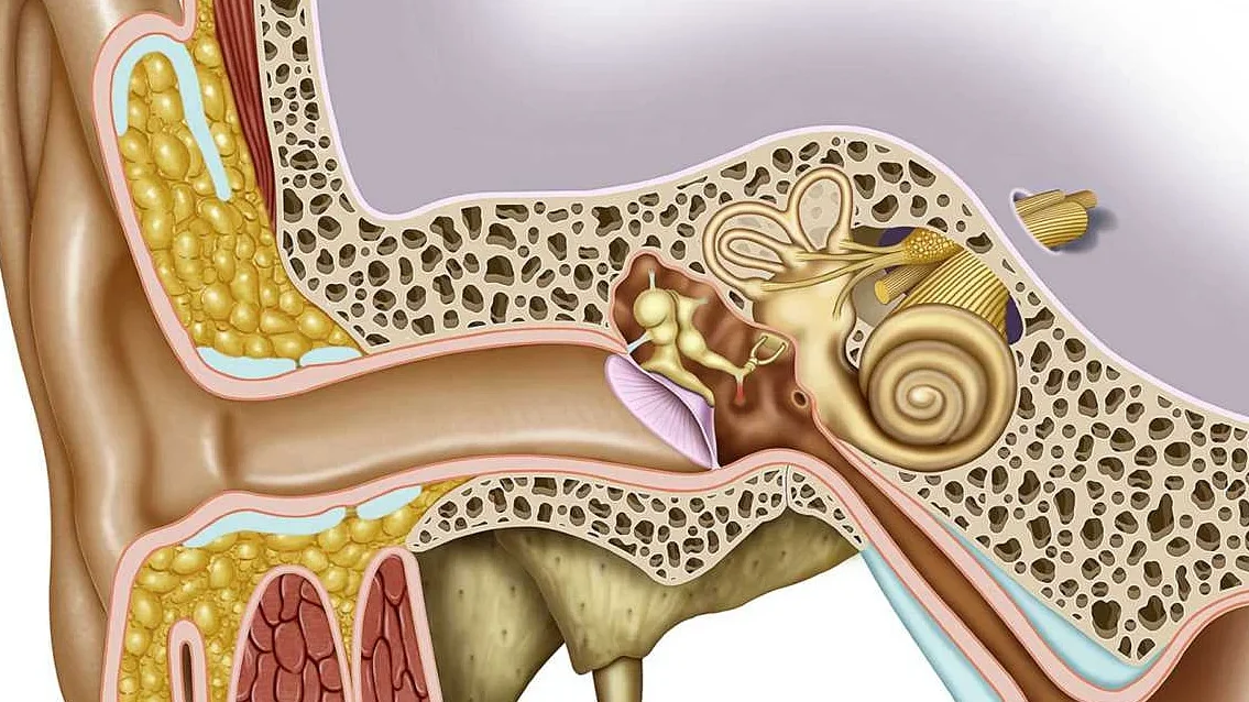 Заложило ухо средство. Отосклероз стапедопластика. Адгезивный отит барабанная перепонка. Кондуктивный отосклероз.