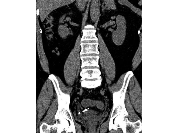 Камень нижней трети правого мочеточника (вид спереди)