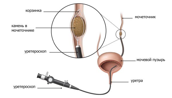 Извлечение камня уретроскопом