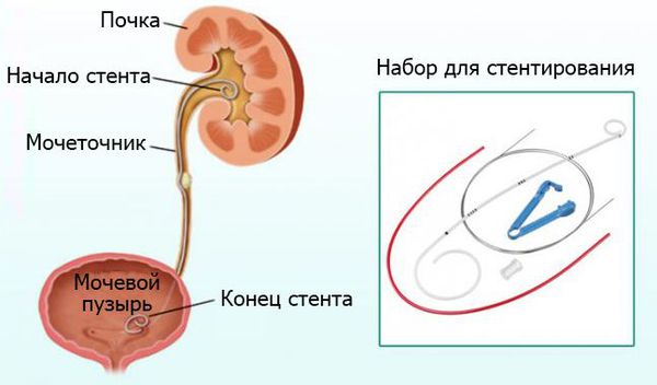 Стентирование мочеточника