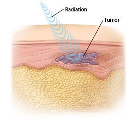 Принцип действия лучевой терапии