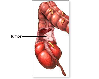 Опухоль кишечника