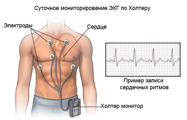 Холтеровское сканирование ЭКГ