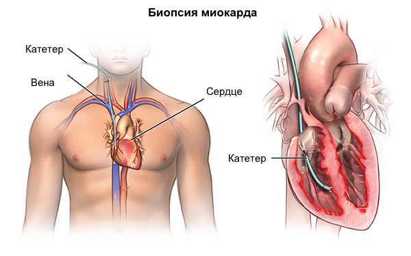 Биопсия миокарда