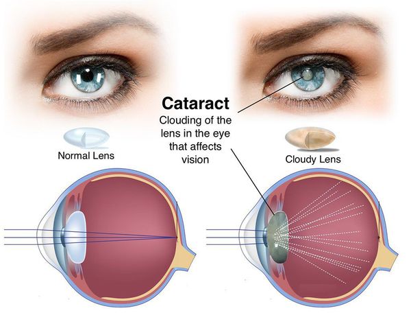 Здоровый и помутневший хрусталик