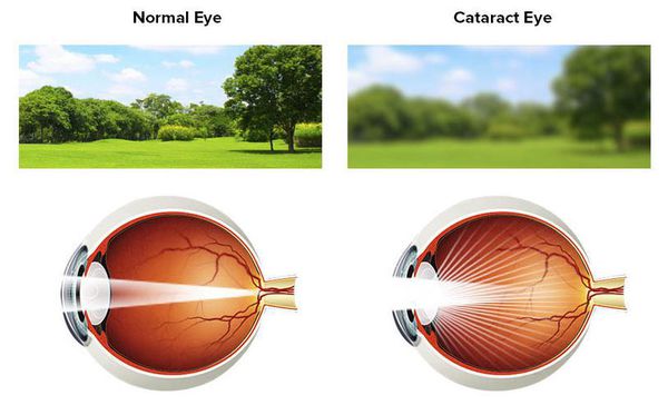 Размытость восприятия при катаракте