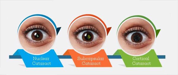 Типы катаракты по локализации