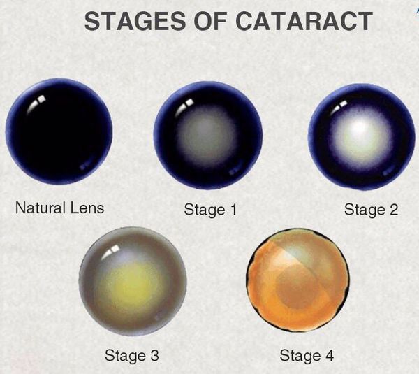 Стадии развития катаракты