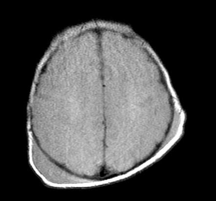 Кефалогематома на КТ-снимке