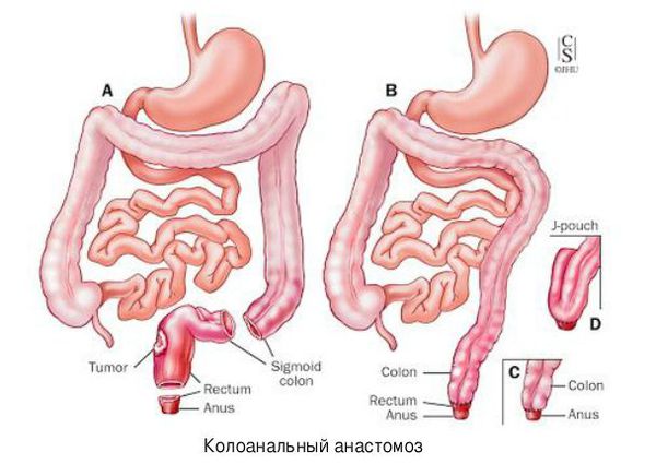 Колоанальный анастомоз