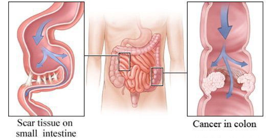 Спайки и опухоль кишечника