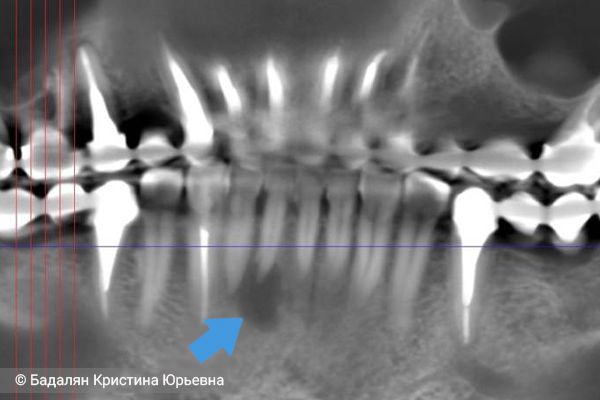 Киста в области нижнего резца