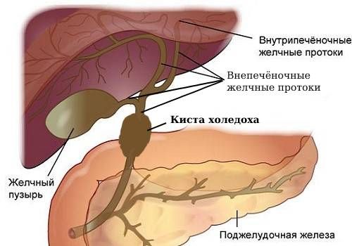 Киста холедоха