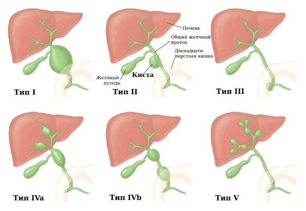 Типы кист холедоха