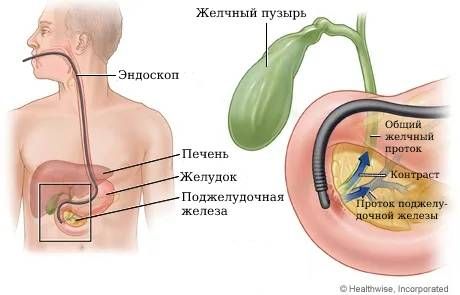 Эндоскопическая ретроградная холангиопанкреатография