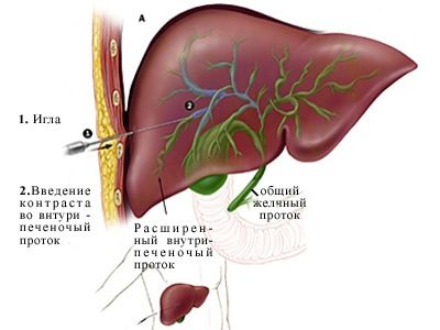Чрезпеченочная холангиография