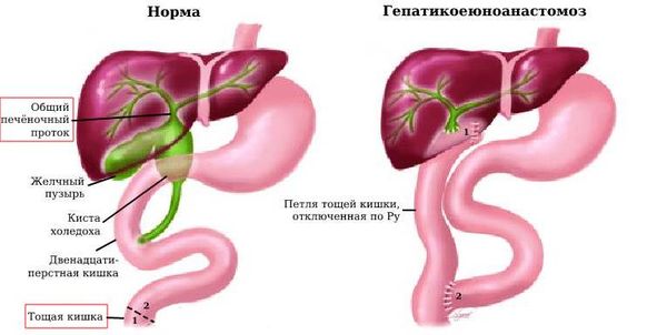 Гепатикоеюноанастомоз 