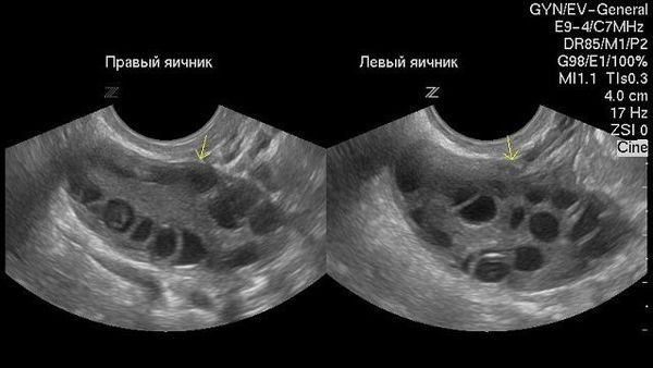 Яичники при ультразвуковом исследовании