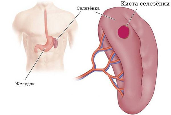 Киста селезёнки