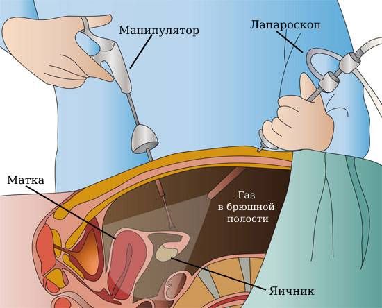 Лапароскопия